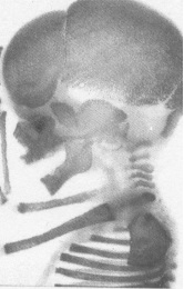 Squelette d'un embryon de 4 mois